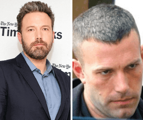 Hollywood celebs with hair loss