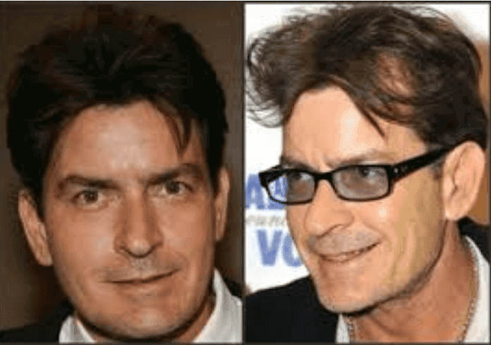 actors with hair loss