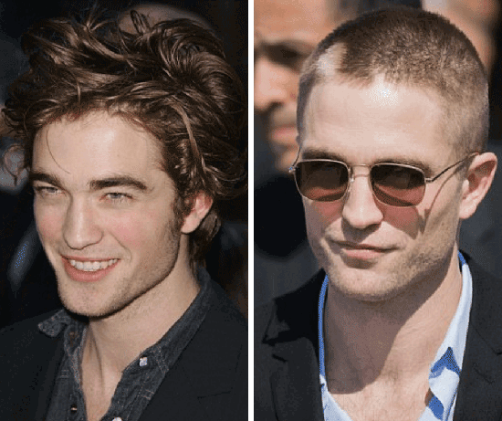 Celebrities with hair loss