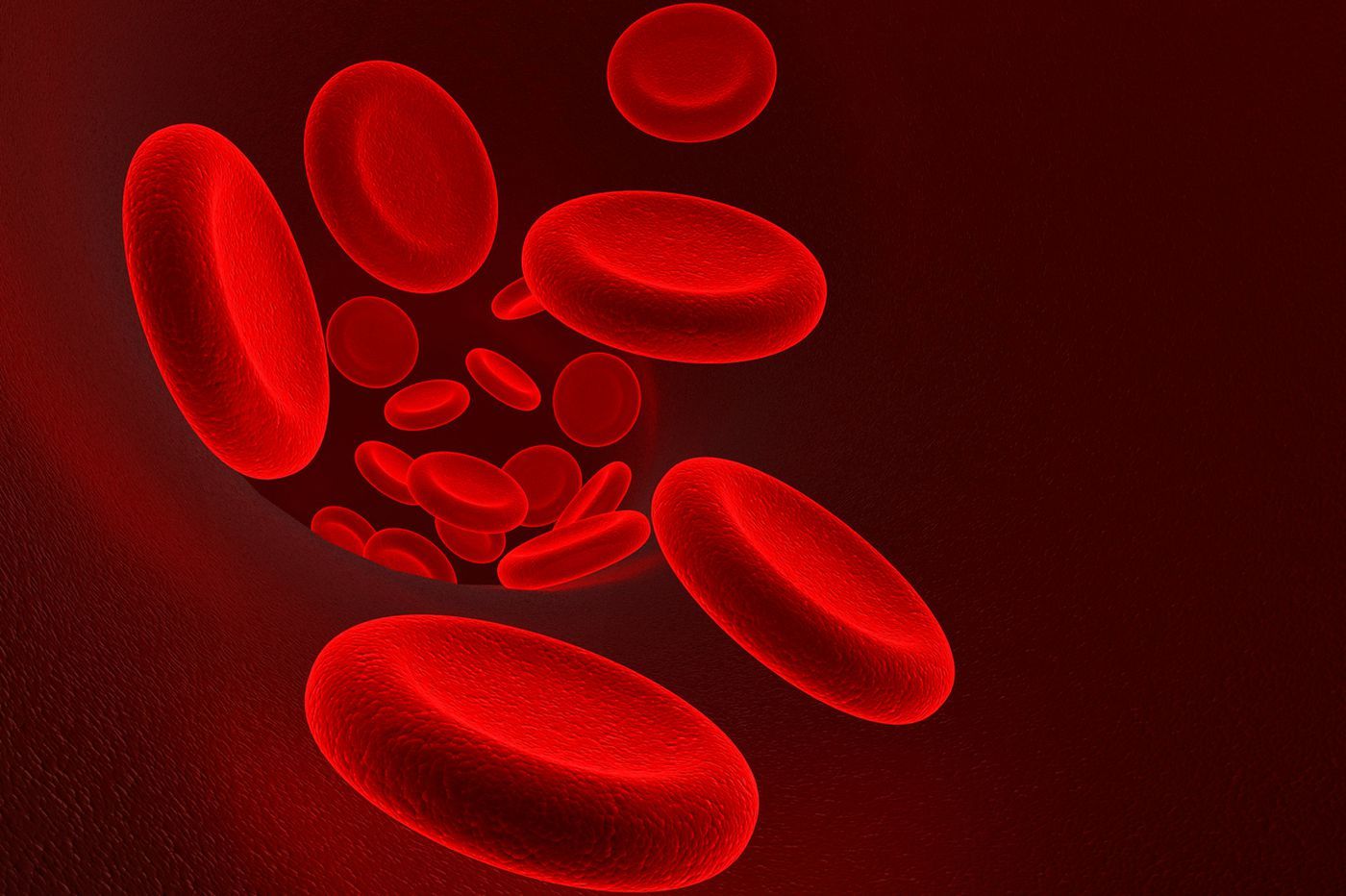 Iron deficiency anemia