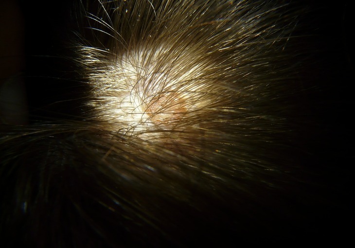 Folliculitis cause hairloss