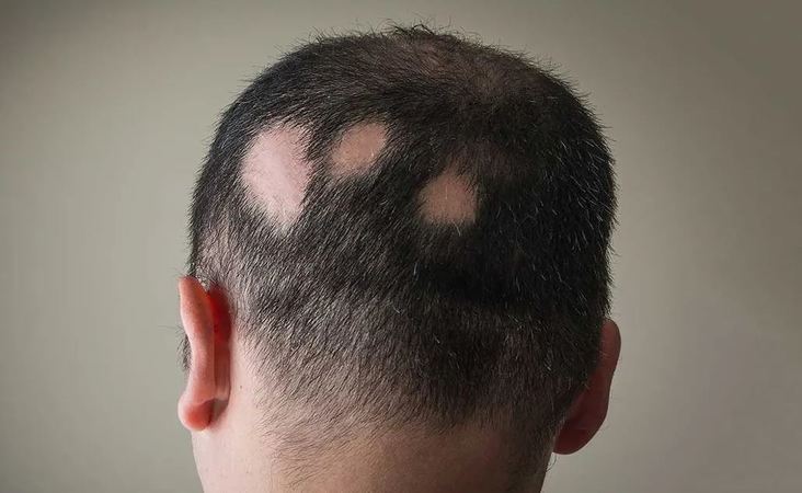 Alopecia areata