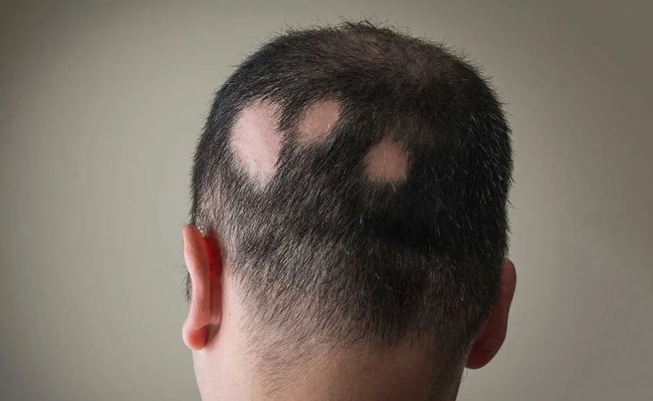 Alopecia areata