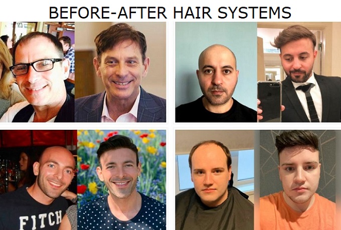 Androgenetic hair loss