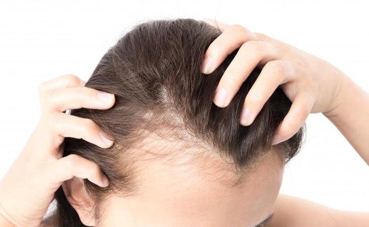 Frontal fibrosing alopecia