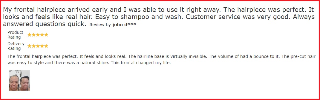 Frontal fibrosing alopecia success story