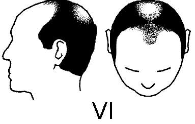 Norwood scale hair loss