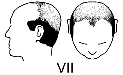 Norwood Scale