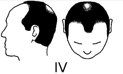 Norwood scale baldness