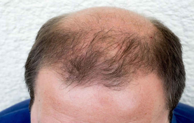 Treatment for genetic hair loss