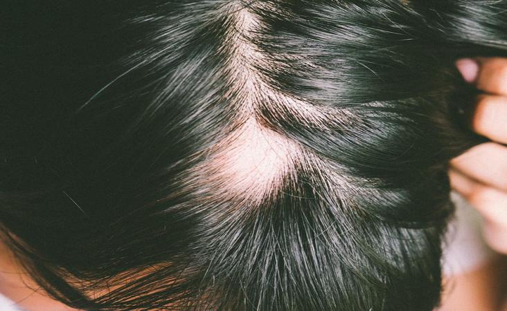 lupus hair loss