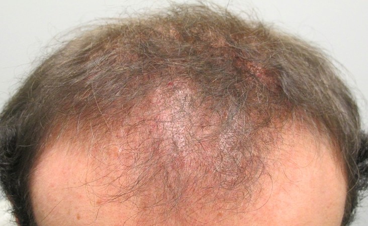 scarring alopecia