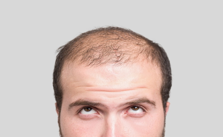 Alopecia areata