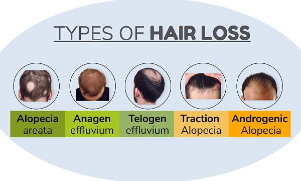 Best hair systems for specific hair loss patterns