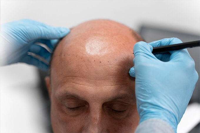 Bioengineered Hair Systems