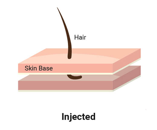 Injected hair
