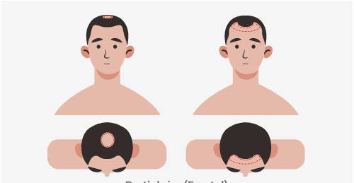 hairline receding