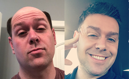 UTS hair system for men