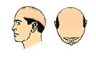 over size hair replacement