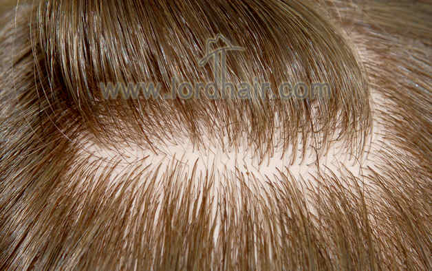 injected silicon hair replacement system