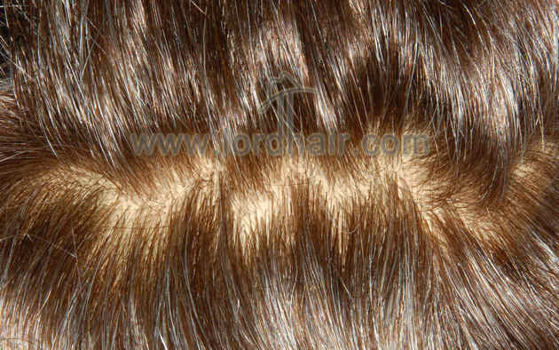 injected silicon hair replacement system