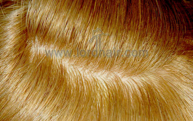 injected silicon hair replacement system