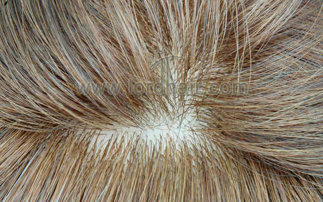 injected silicon hair replacement system