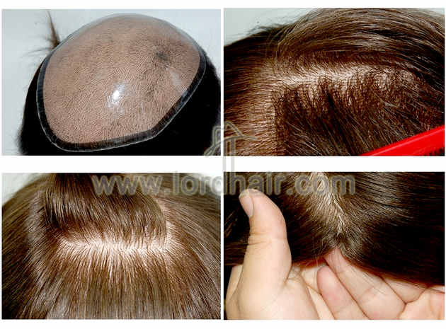 injected silicon hair replacement system