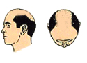 standard hair replacement